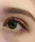盐城做了双眼皮不明显怎么办
