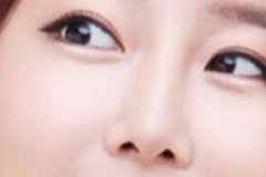 盐城埋线双眼皮效果不明显怎么办？