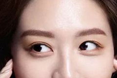 盐城埋线双眼皮效果是永久的吗？