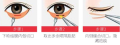 盐城做眼袋整形会留下疤痕吗