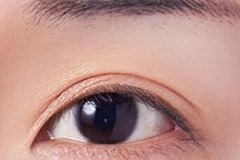 盐城上眼皮松弛怎么办