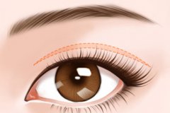 盐城眼睑下垂形成原因以及治疗方法
